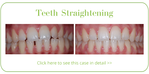 Teeth Straightening Skegness